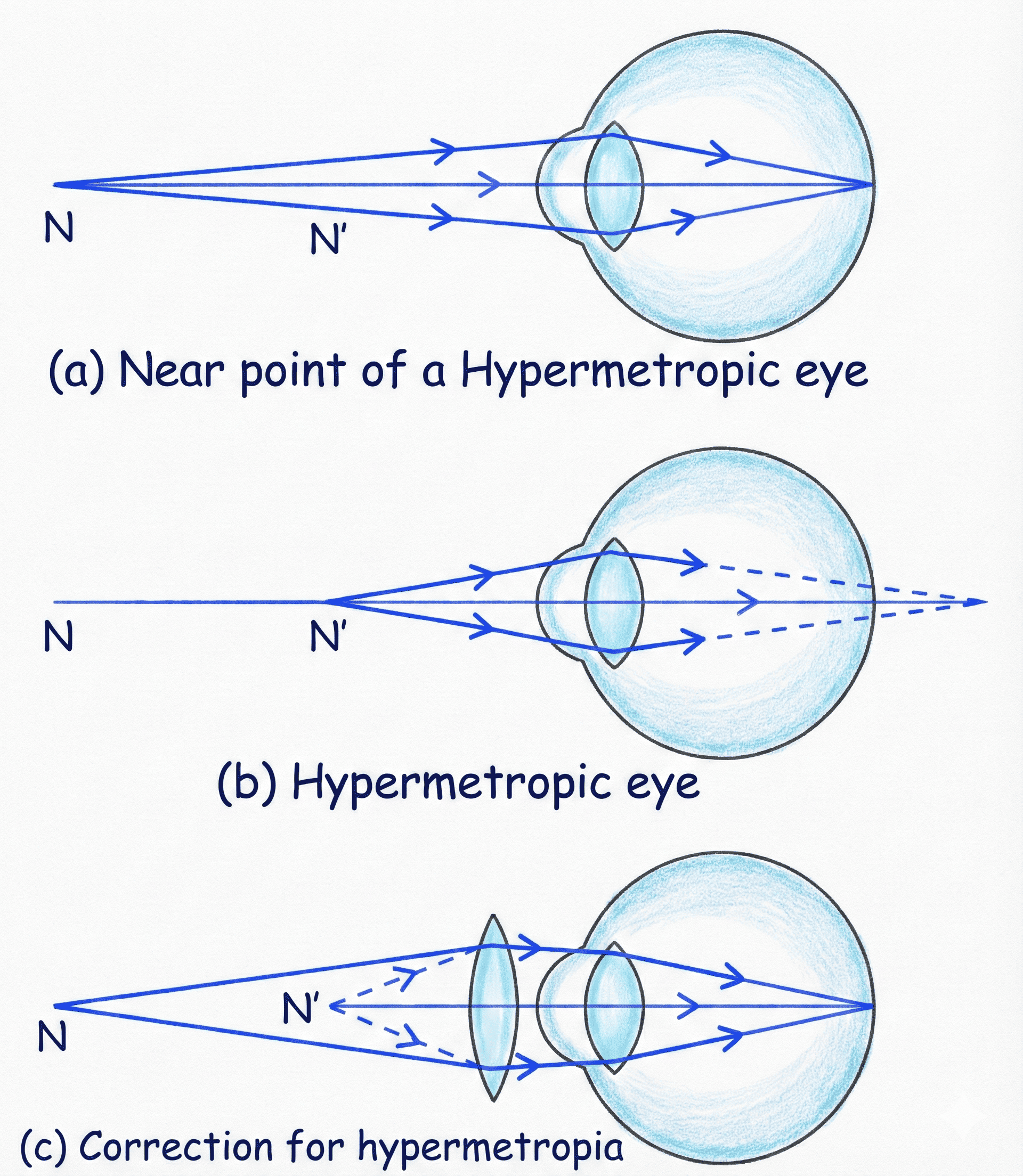 Hypermetropia (Defect and Correction)