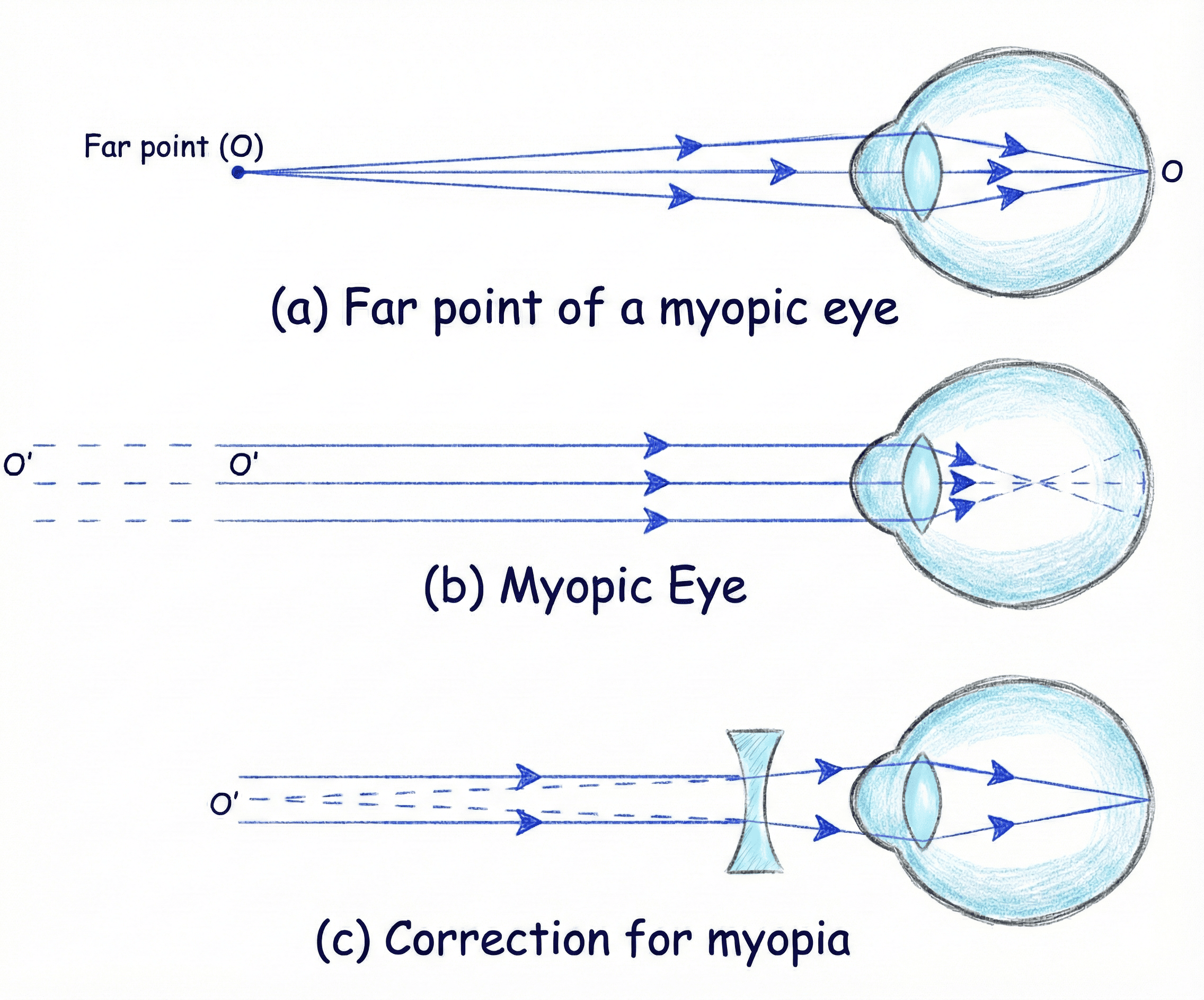 Myopia (Defect and Correction)